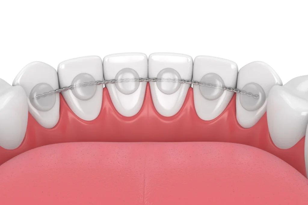 aligneur contention geneve Contention Dr Stéphane VINCENT BARTOLI, Orthodontie à Douvaine
