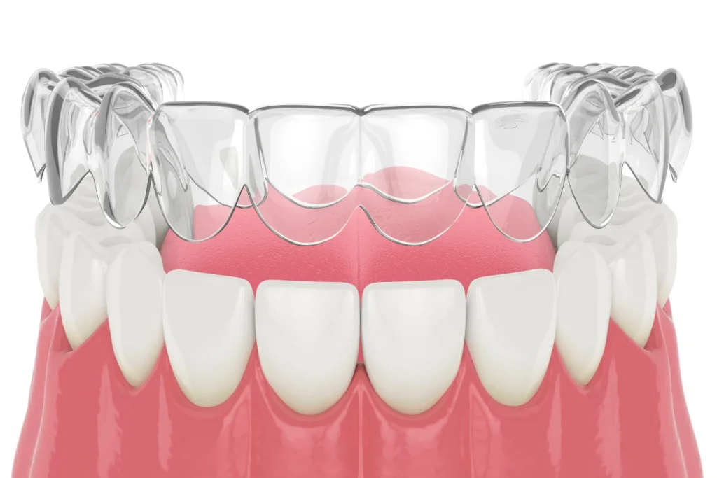 aligneur invisible contention geneve Contention Dr Stéphane VINCENT BARTOLI, Orthodontie à Douvaine