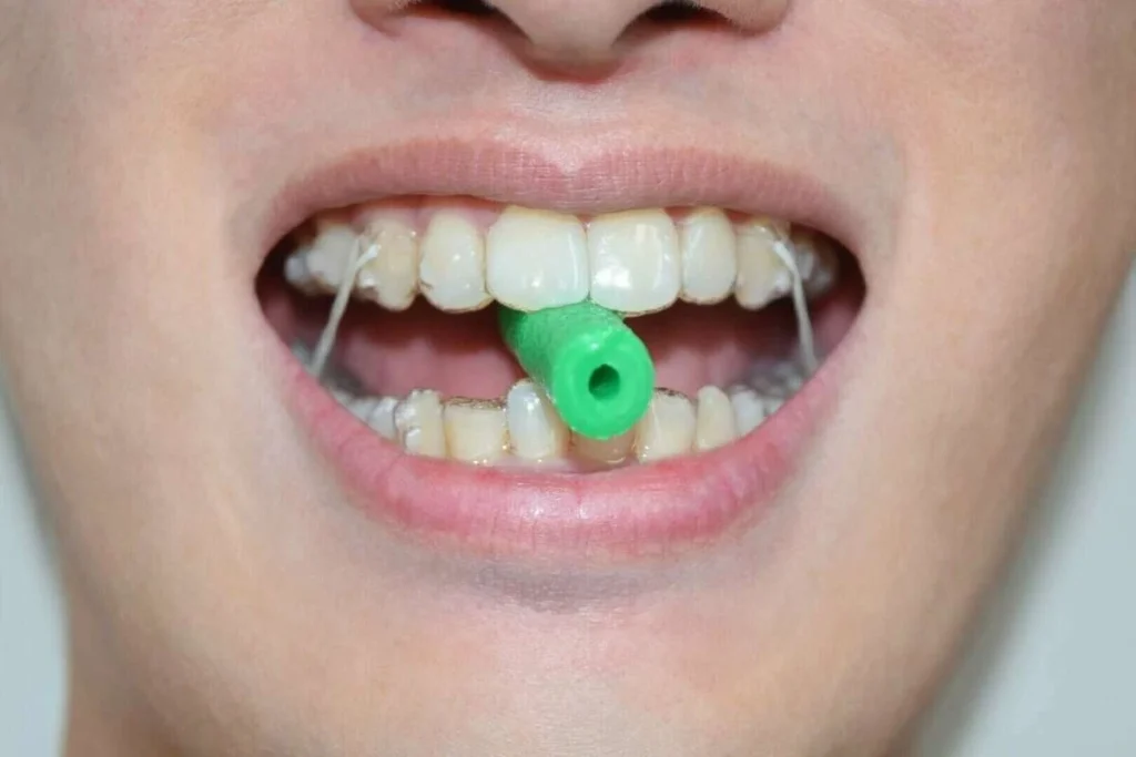 chewies gouttieres orthodontie geneve chewies gouttieres orthodontie geneve Aligneurs transparents Dr Stéphane VINCENT BARTOLI, Orthodontie à Douvaine