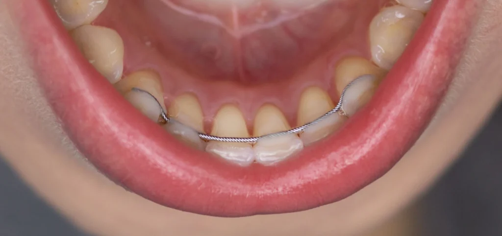 contention fixe geneve Contention Dr Stéphane VINCENT BARTOLI, Orthodontie à Douvaine