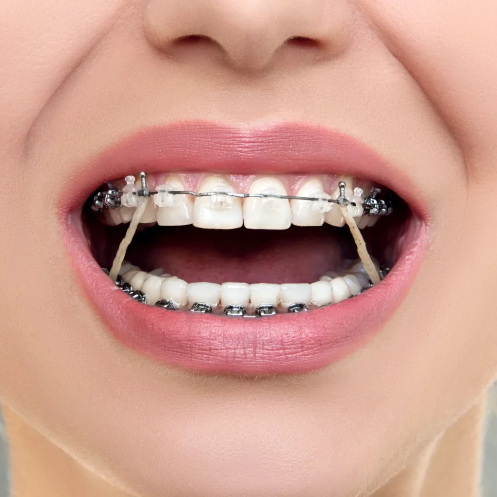 elastiques orthodontie douvaine geneve Appareil dentaire : multi-attaches Dr Stéphane VINCENT BARTOLI, Orthodontie à Douvaine