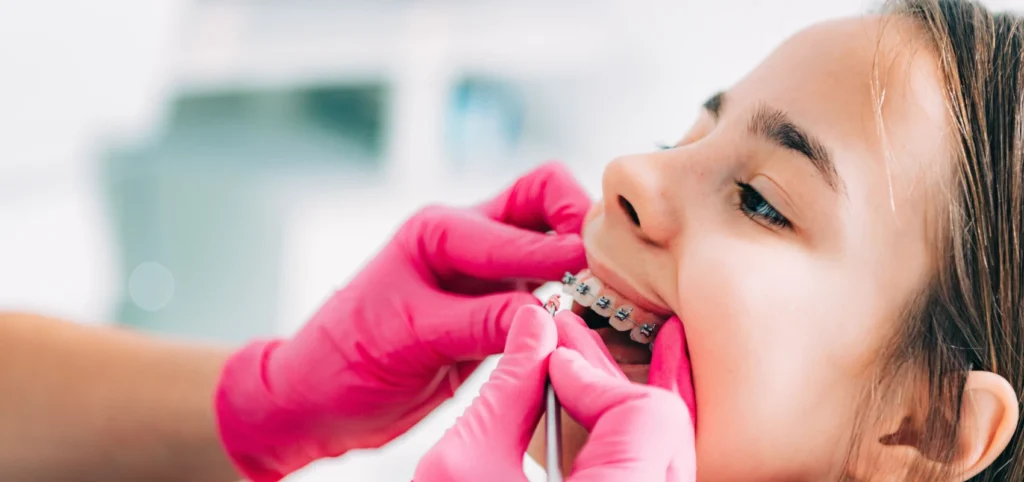 orthodontie adolescent multi attaches geneve Appareil dentaire : multi-attaches Dr Stéphane VINCENT BARTOLI, Orthodontie à Douvaine